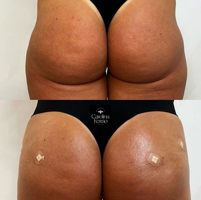 Harmonização de Glúteo